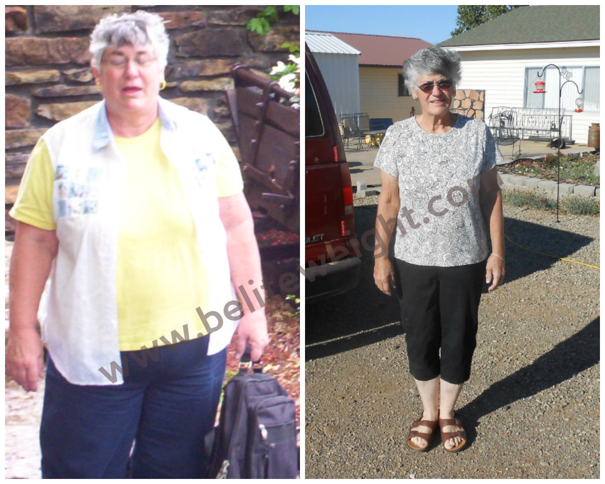 weight loss surgery success story