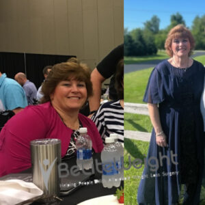 Gastric Bypass Revision Before And After Photos