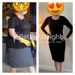 Gastric Bypass Revision Before And After Photos