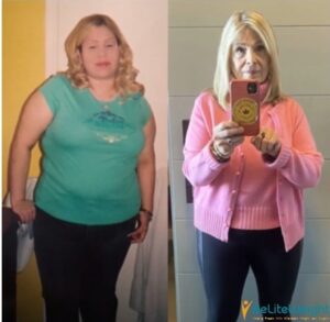 Ozempic Weight Loss Before and After Pictures