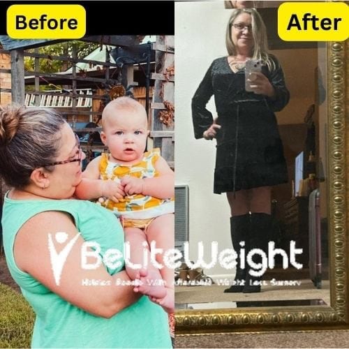 Sherrie Guilliams- 1 year after gastric sleeve